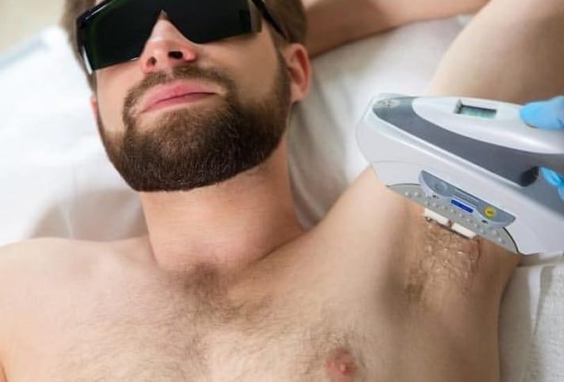 Laser Hair Removal
