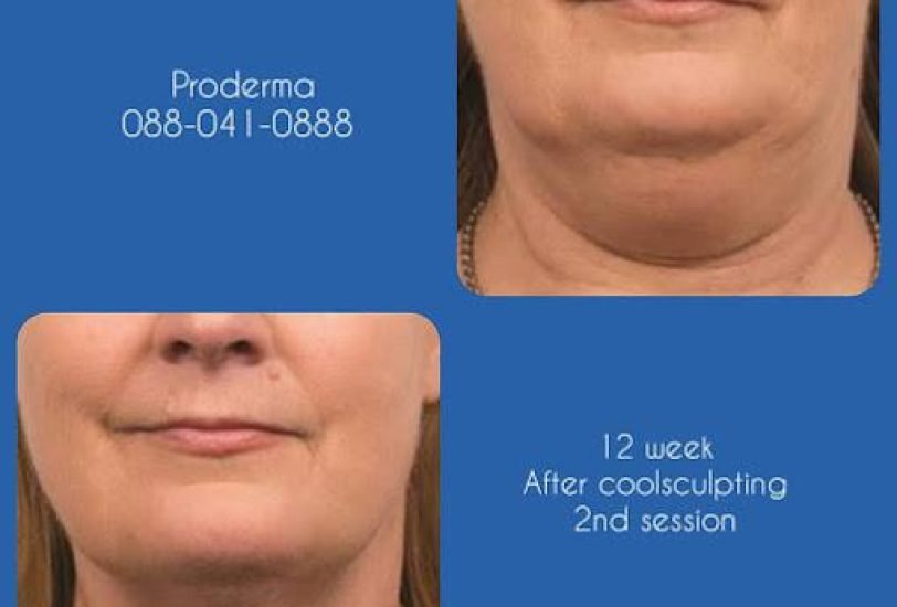 Facial Contouring & Lifting