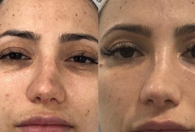 Acne & Scar Treatments