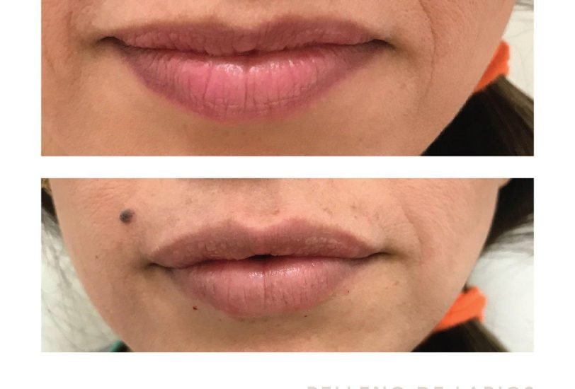 Lips Treatments