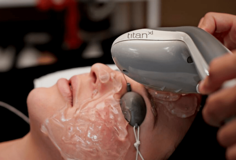 Laser Hair Removal