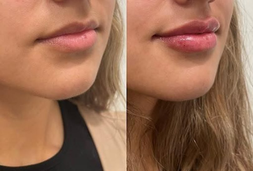 Lips Treatments