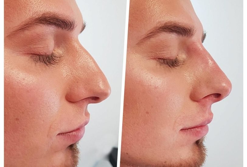 Facial Contouring & Lifting