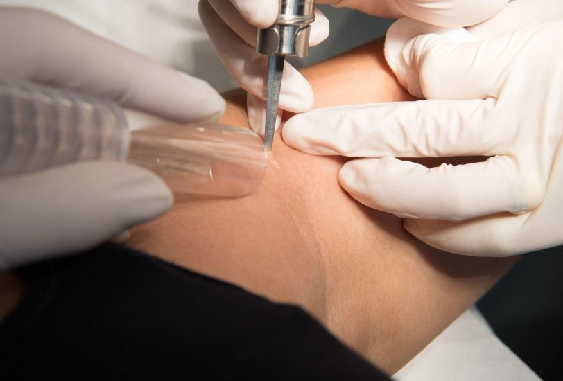 Vein Treatments