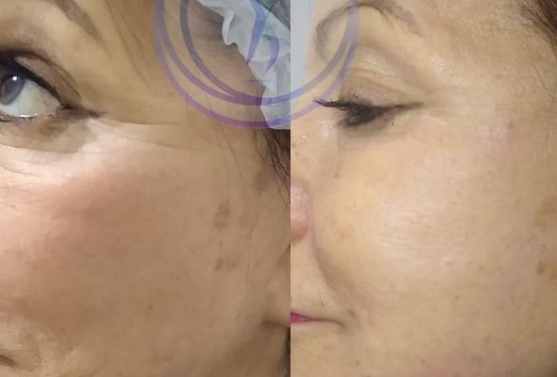 Anti-Aging Treatments