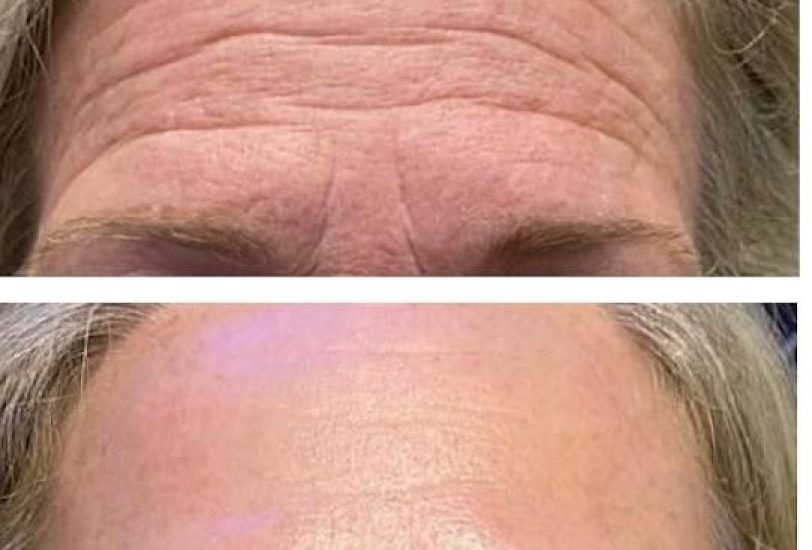 Anti-Aging Treatments