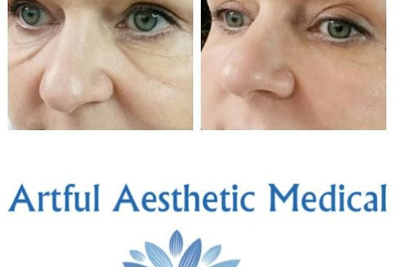 Eye Rejuvenation