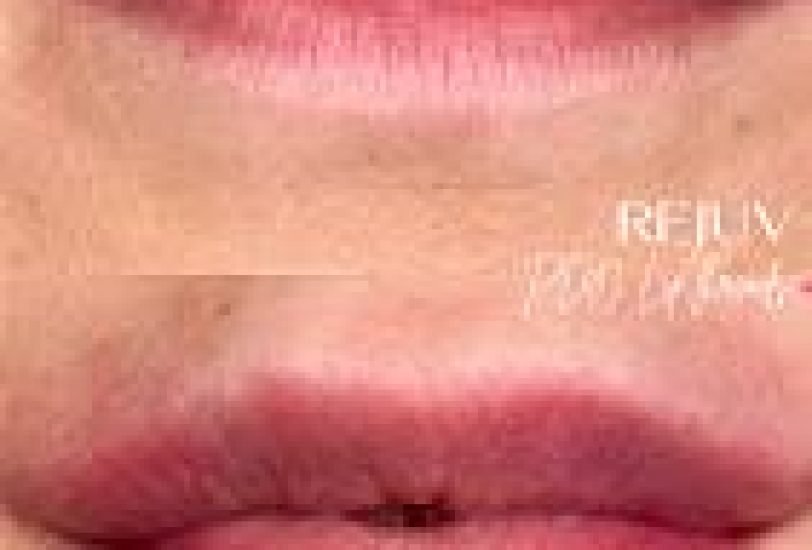 Lips Treatments