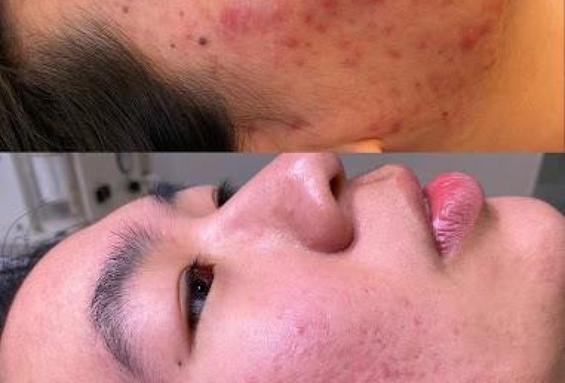 Acne & Scar Treatments