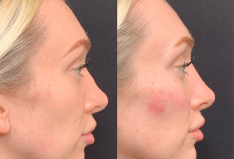 Skin MD Boston 4 – VerifiedCare Fat Transfer
