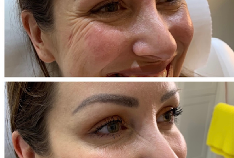 Acne & Scar Treatments