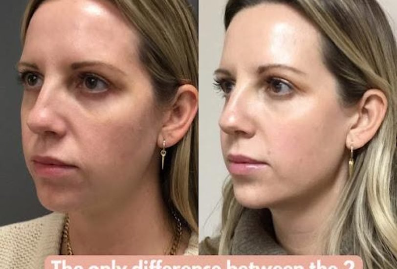 Double Chin & Jawline Contouring