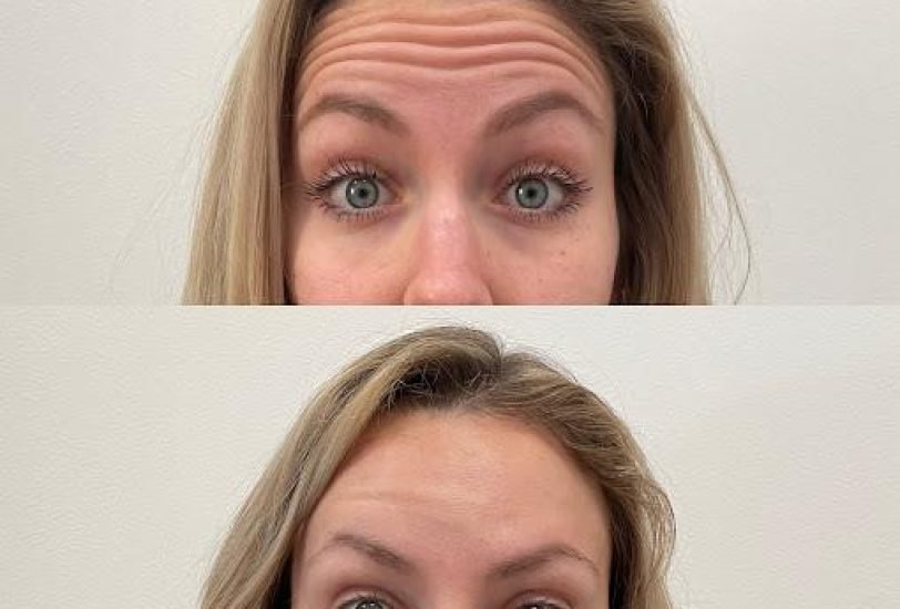 Injectable Treatments