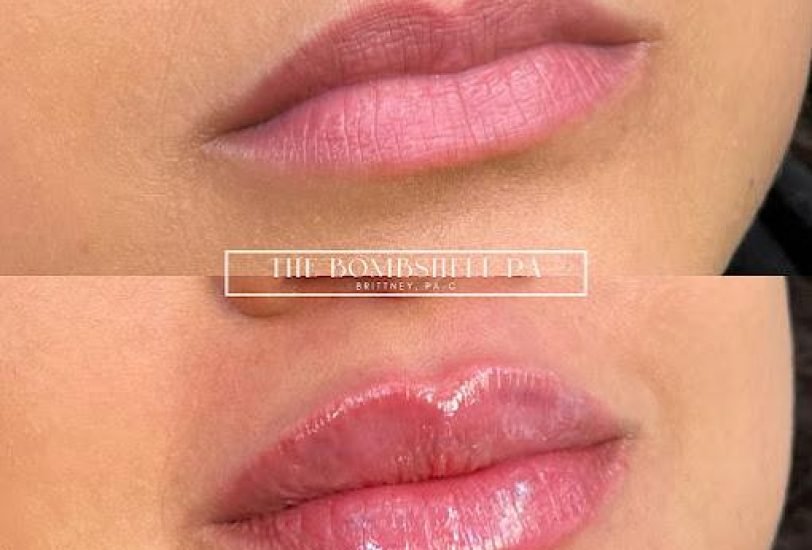Injectable Treatments