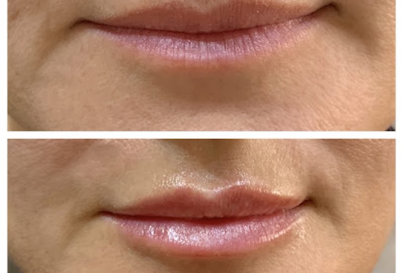 Lips Treatments