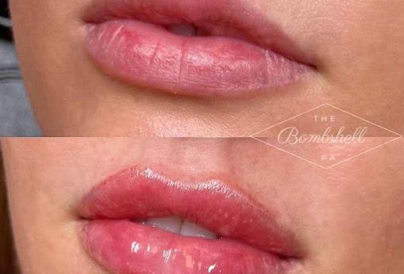 Lips Treatments