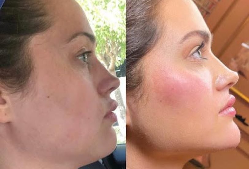 Double Chin & Jawline Contouring