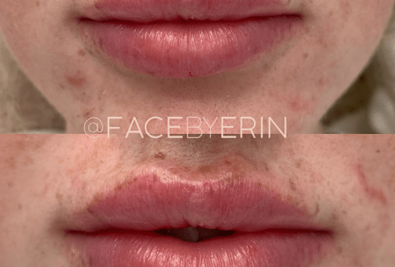 Lips Treatments