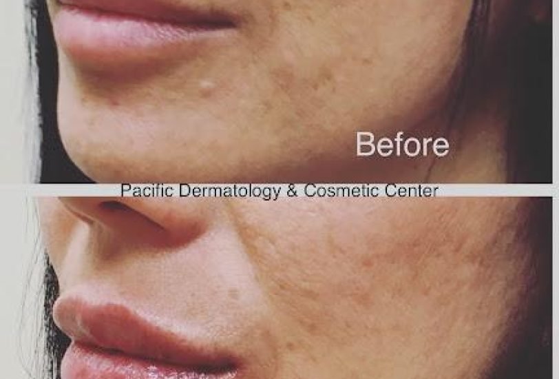 Double Chin & Jawline Contouring