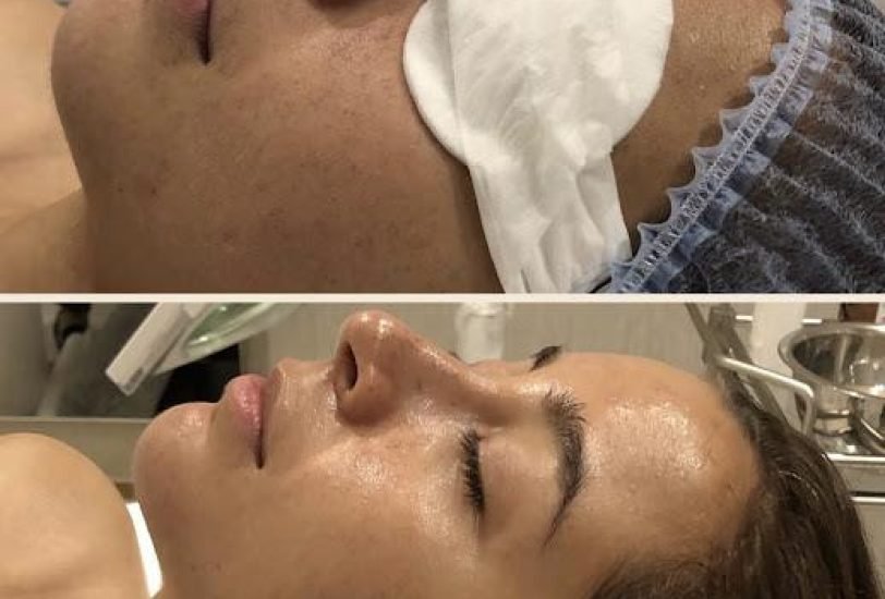 Double Chin & Jawline Contouring