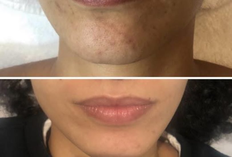 Acne & Scar Treatments
