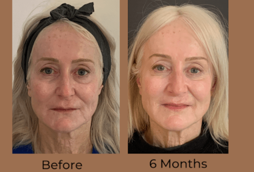 Anti-Aging Treatments