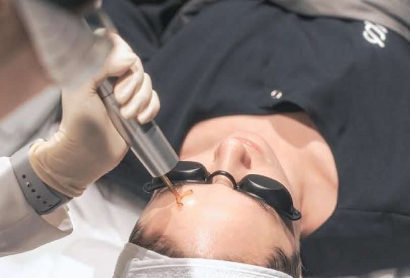 Laser Hair Removal