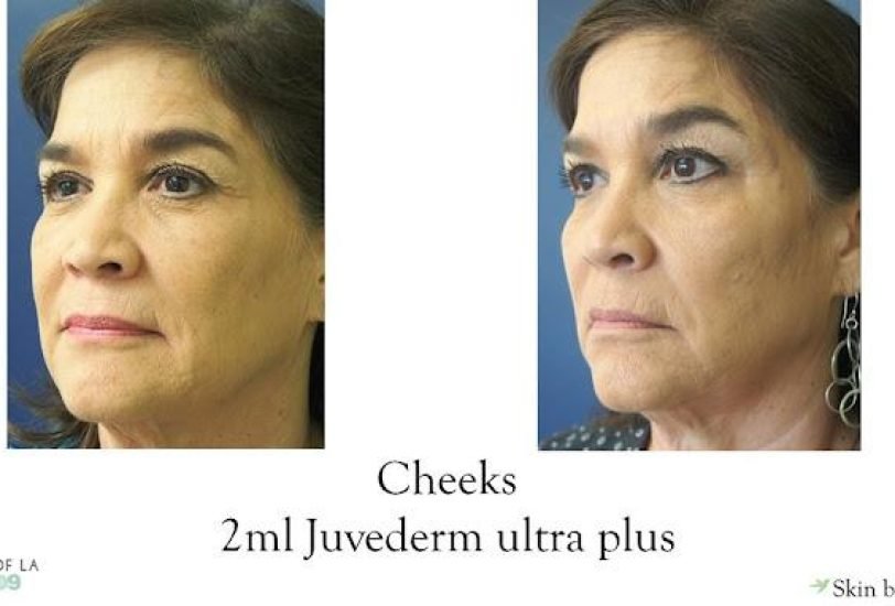 Fat Reduction Injections