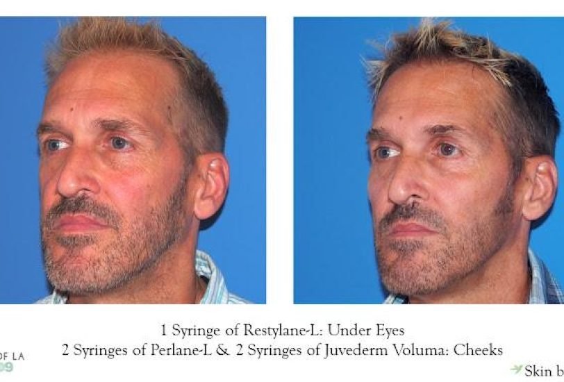 Skin Tightening