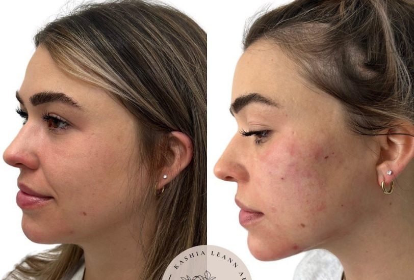 Injectable Treatments