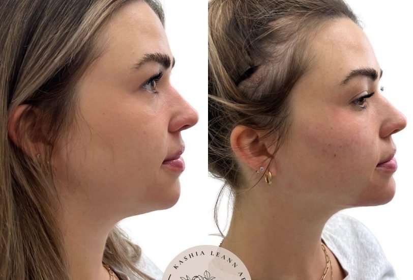 Skin Rejuvenation