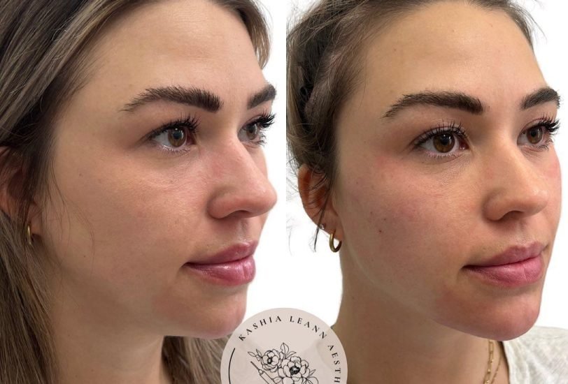 Double Chin & Jawline Contouring