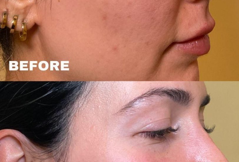 Acne & Scar Treatments