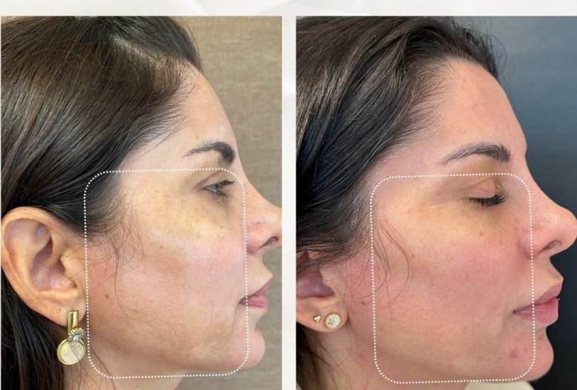 Acne & Scar Treatments