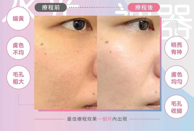 Acne & Scar Treatments