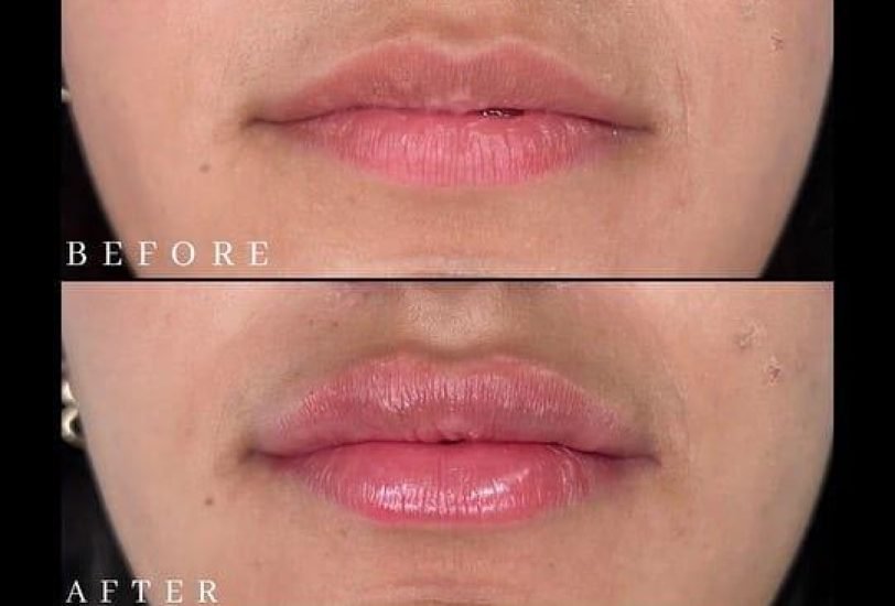 Lips Treatments