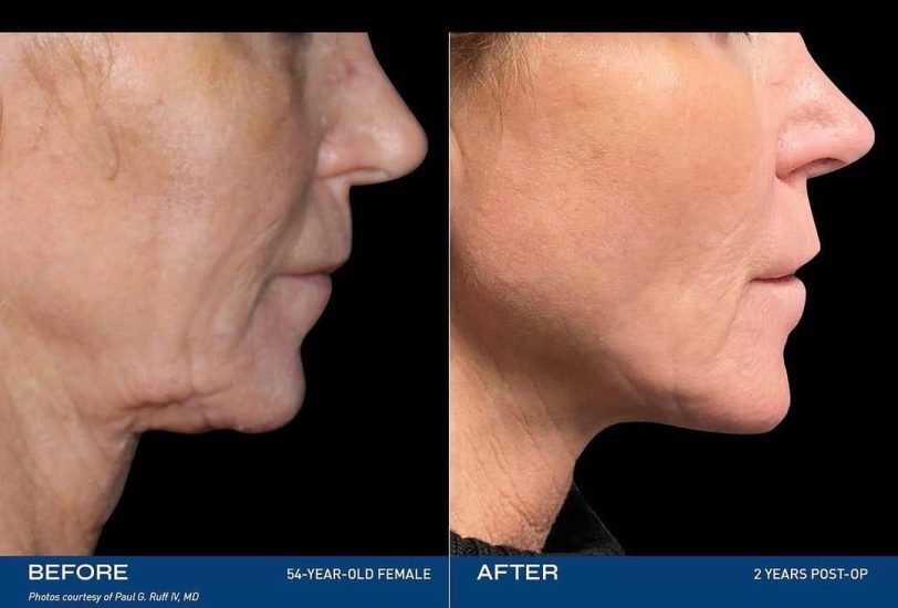 Skin Tightening