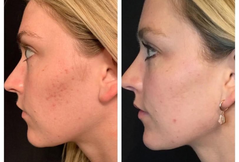 Double Chin & Jawline Contouring
