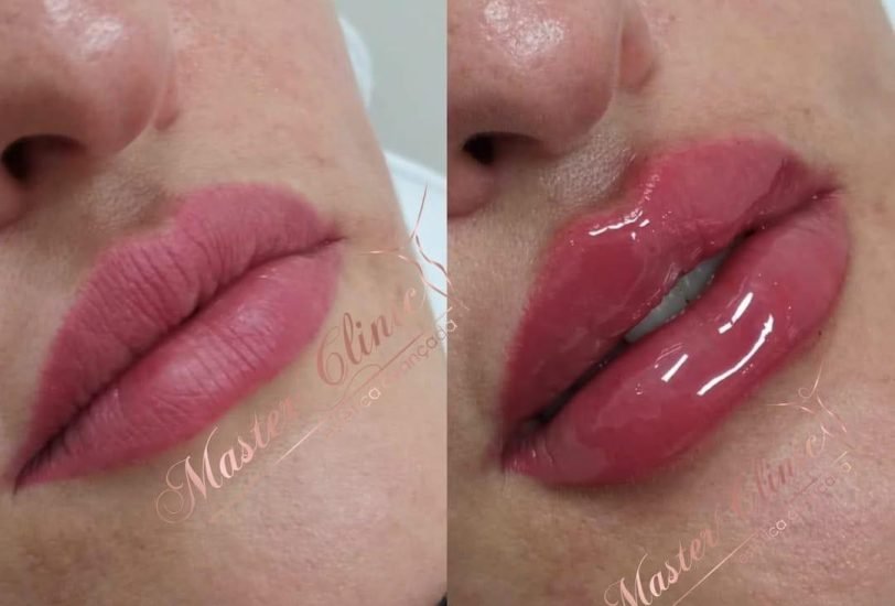 Lips Treatments