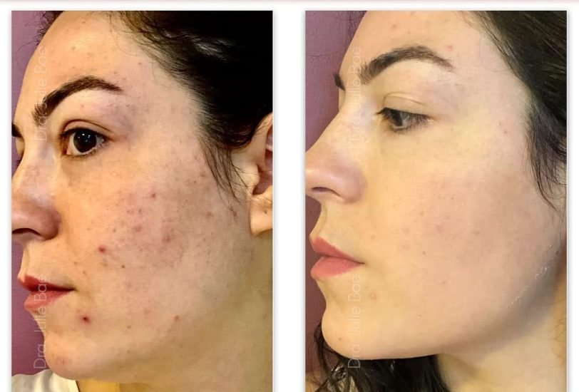 Acne & Scar Treatments