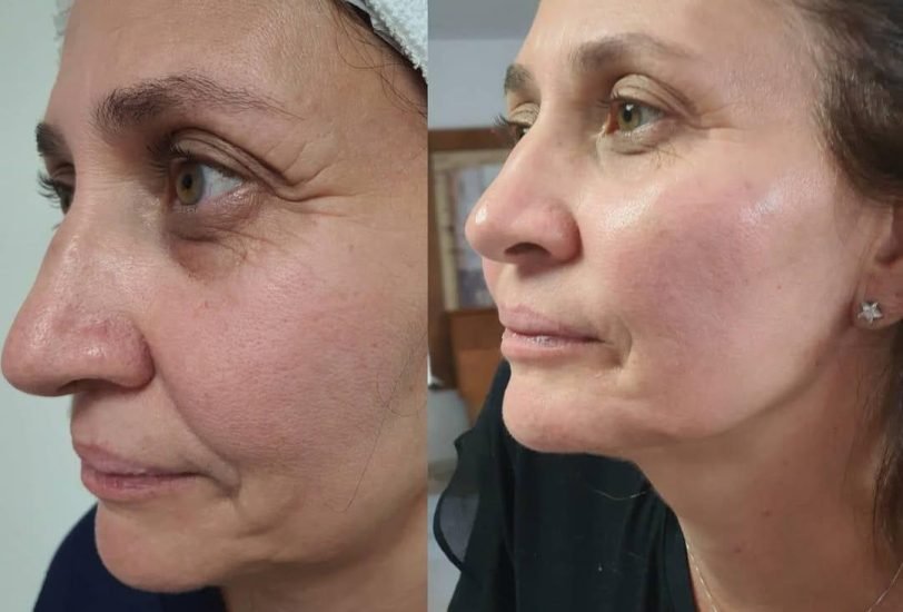 Anti-Aging Treatments