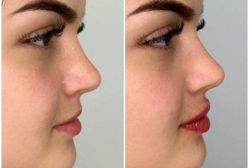 Facial Contouring & Lifting