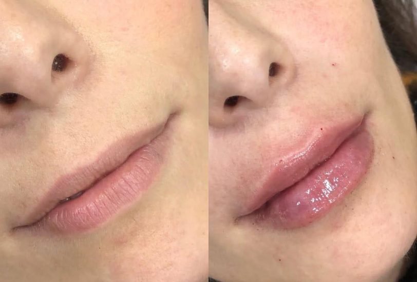 Lips Treatments