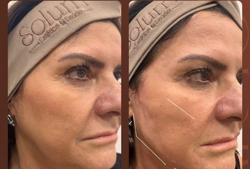 Facial Contouring & Lifting