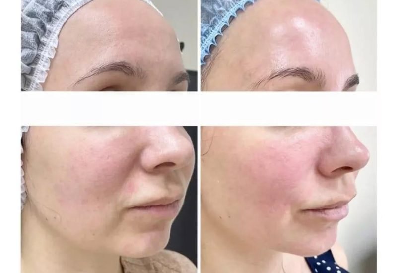 Skin Rejuvenation