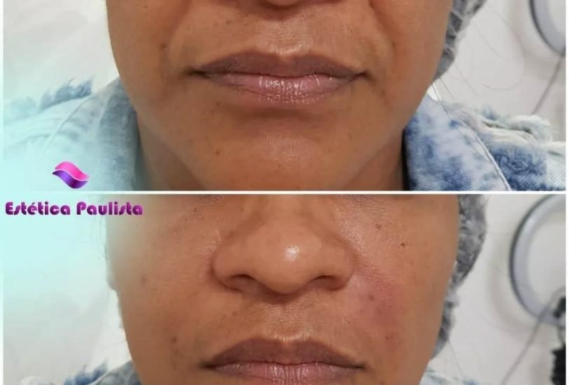 Pigmentation & Skin Tone Correction