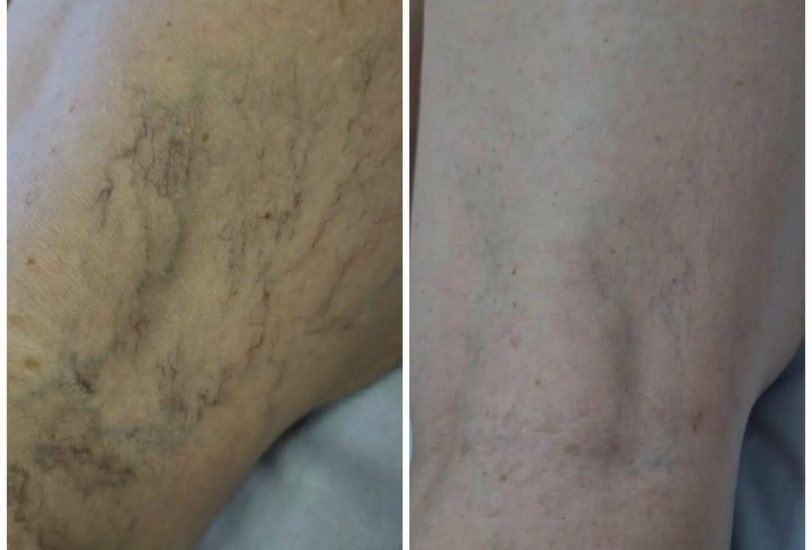 Vein Treatments