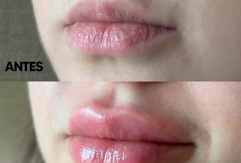 Lips Treatments