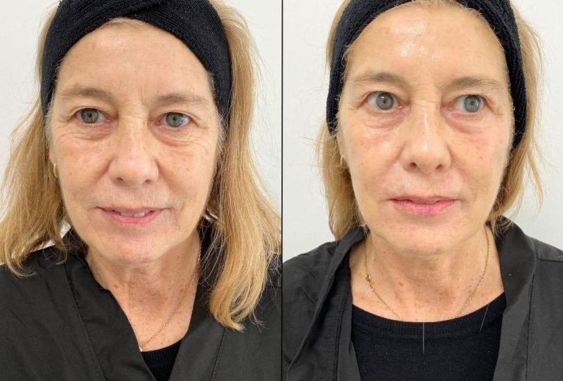Anti-Aging Treatments