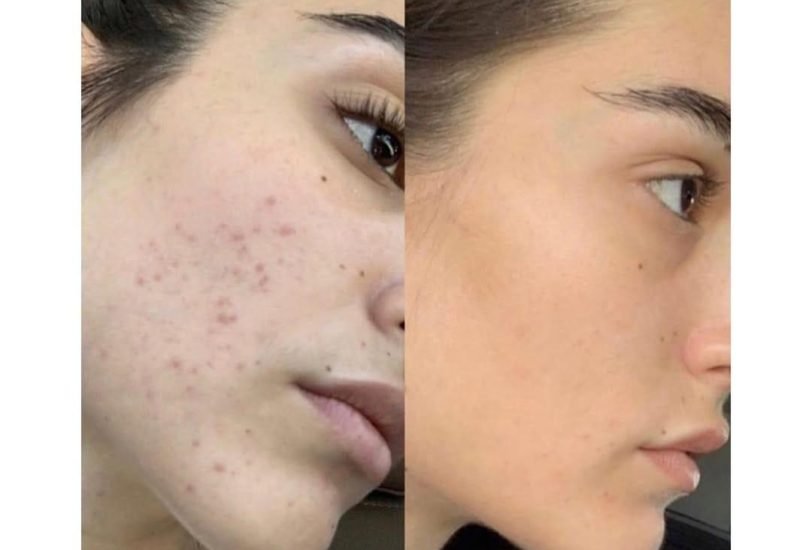 Acne & Scar Treatments
